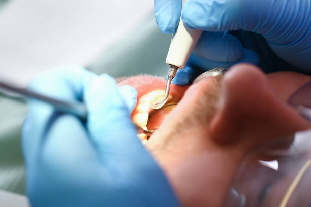 Best Urgent Care for Lost Fillings or Crowns in Henderson, KY